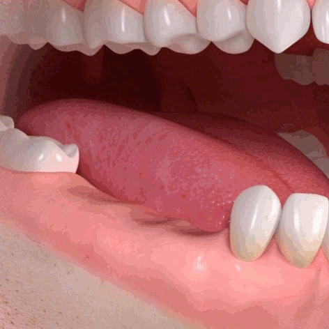 Implanty zębów - most na implantyach