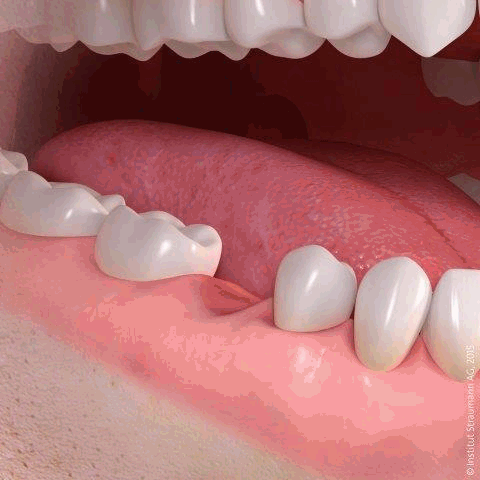 Implanty zębów - pojedynczy ząb